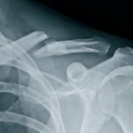 Breaking a Collarbone – What to Do