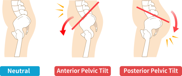 anterior pelvic tilt women