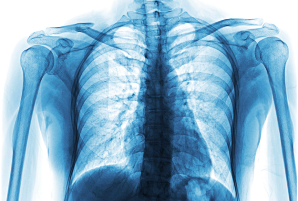 x-ray showing shoulder joint